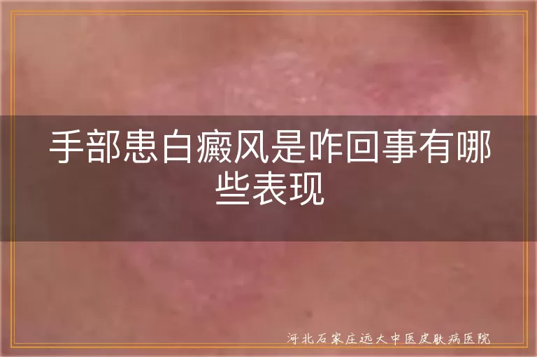 手部白癜风症状,白斑表现特点,白癜风发病原因