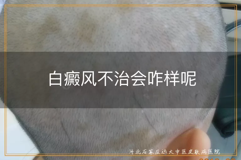 白癜风扩散影响,白斑引发并发症,白癜风降低生活质量