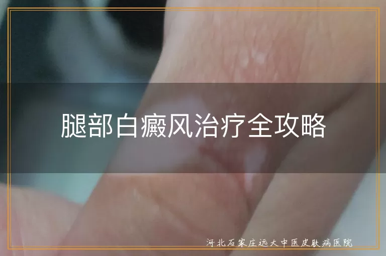 腿部白癜风治疗方法,白癜风药物治疗与光疗,白斑生活调理与预防