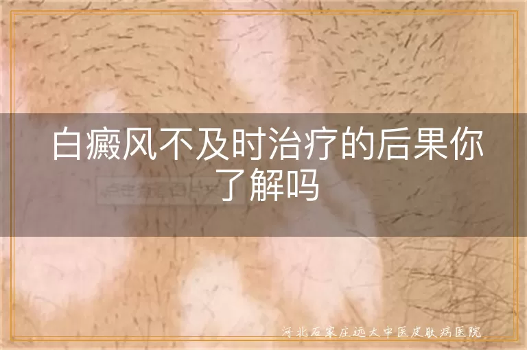 白癜风扩散影响,白斑并发症风险,白癜风心理健康问题