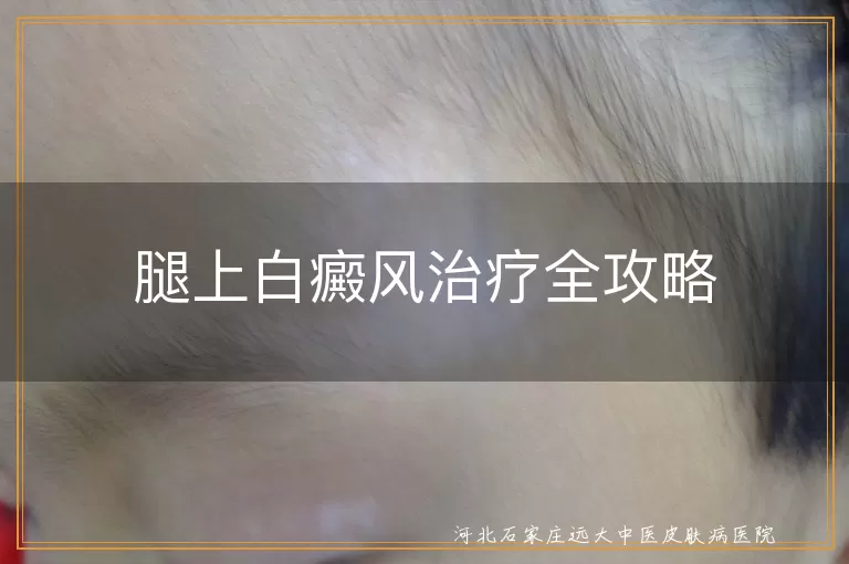 腿上白癜风治疗方法,白癜风生活调理注意事项,白癜风心态调整与康复