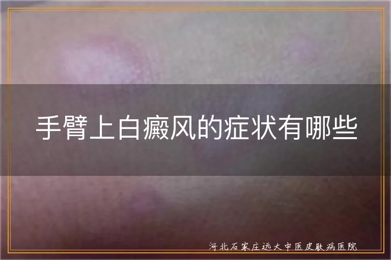 手臂白癜风白斑症状,白癜风皮肤感觉异常,白癜风毛发变白情况