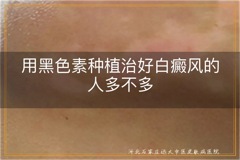 黑色素种植治疗白癜风效果如何,白斑患者黑色素移植成功率,白癜风新技术毛囊黑色素移植