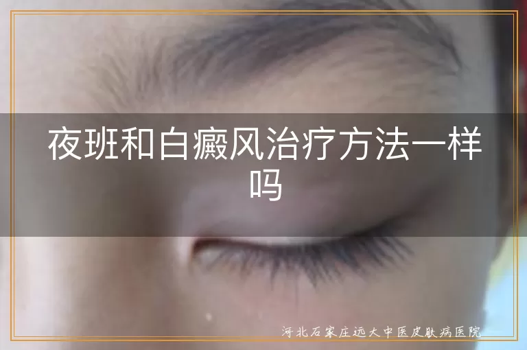 夜班和白癜风治疗方法一样吗