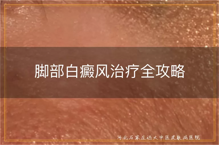 脚部白癜风治疗方法,白癜风生活调理建议,白癜风治疗误区及细节
