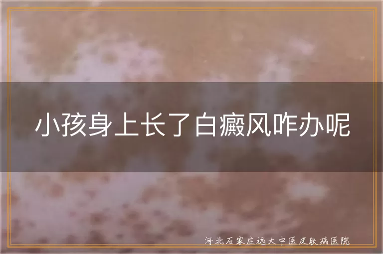 小孩白癜风治疗方法,儿童白斑饮食调整,白癜风复发预防