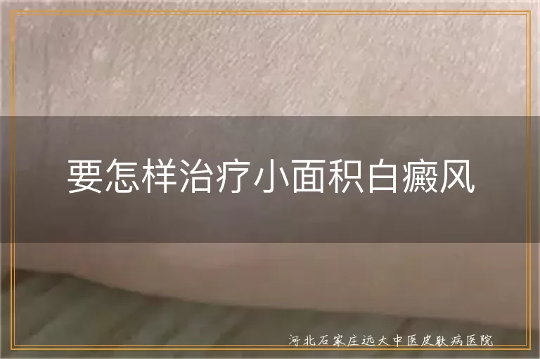 小面积白癜风治疗方法,白癜风生活调理注意事项,白癜风中医治疗方式