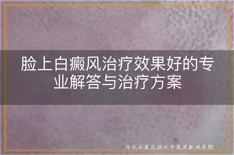 脸上白癜风治疗方法,白斑科学治疗方案,白癜风有效治疗手段