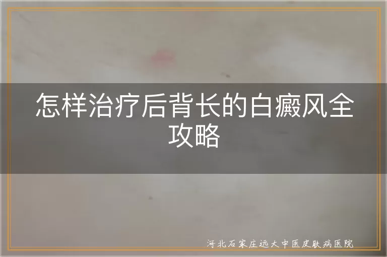 后背白癜风治疗方法,白斑如何科学治疗,预防白癜风复发措施