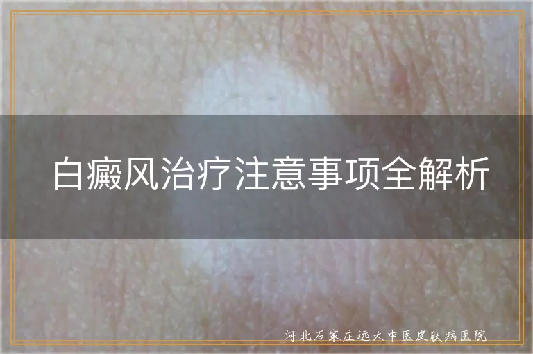 白癜风治疗注意事项全解析