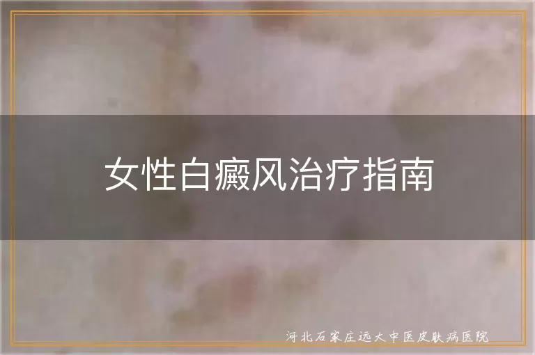 女性白癜风治疗方法,白斑药物治疗与光疗,白癜风心理支持与护理