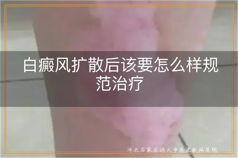 白癜风扩散后该要怎么样规范治疗
