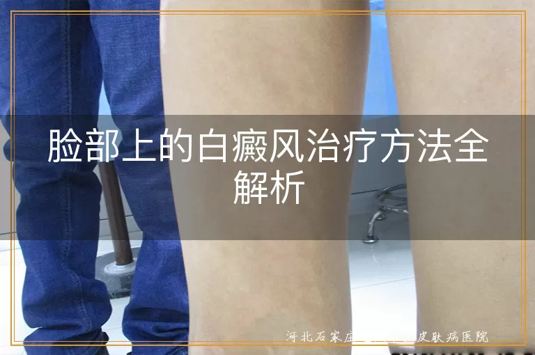 脸部白癜风治疗方法,白斑如何消除,白癜风治愈攻略