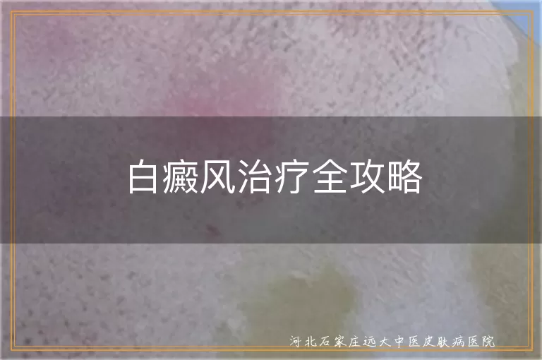 白癜风药物治疗方法,白癜风光疗效果,白癜风心理治疗重要性