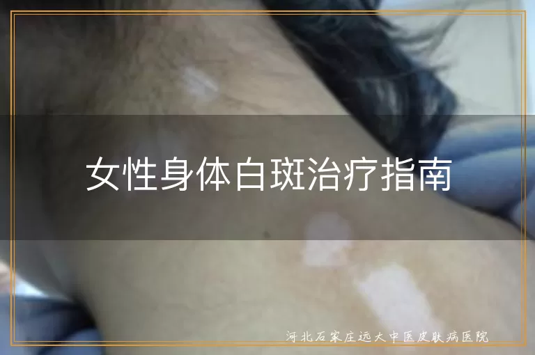 女性身体白斑治疗指南