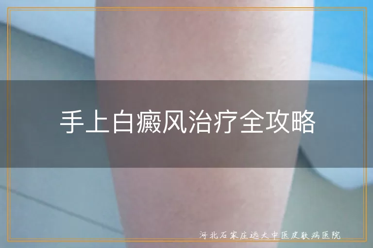 手上白癜风治疗方法,白癜风药物治疗与光疗,白斑中医治疗与护理