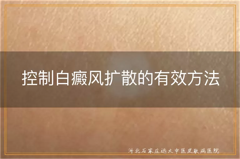 白癜风扩散控制方法,白斑预防扩散策略,白癜风科学治疗与护理