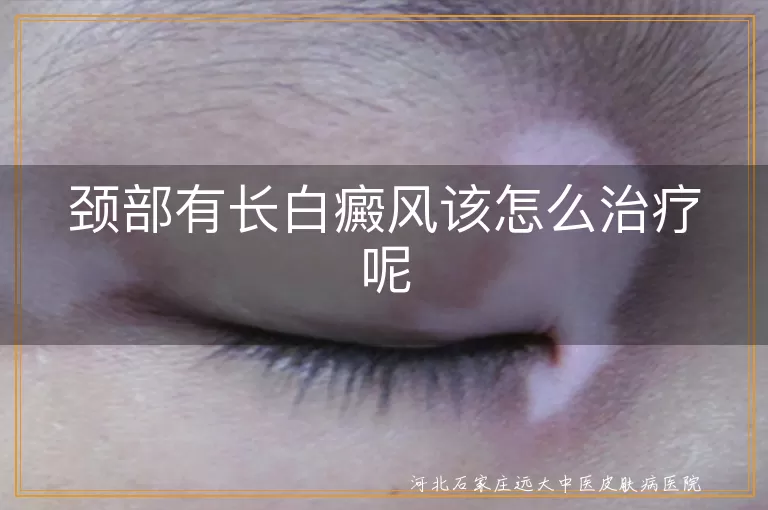 颈部白癜风治疗方法,白斑如何控制扩散,白癜风心理治疗重要性