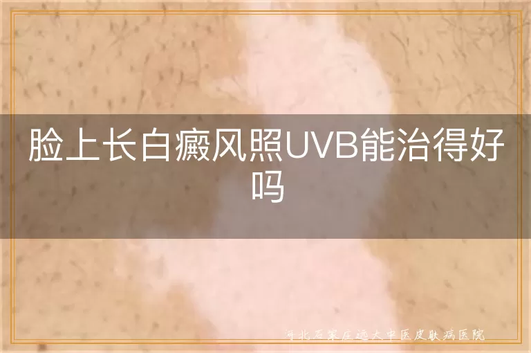 脸上长白癜风照UVB能治得好吗