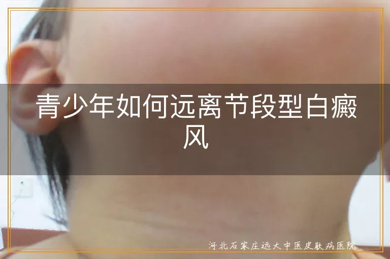 青少年如何远离节段型白癜风