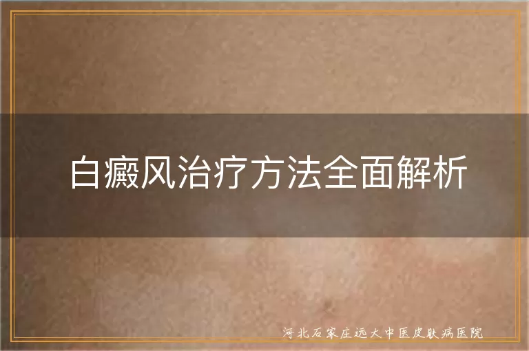 白癜风治疗方法全面介绍 白斑治疗多种方法解析 白癜风综合治疗方案详解