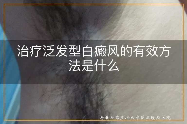 治疗泛发型白癜风的有效方法是什么