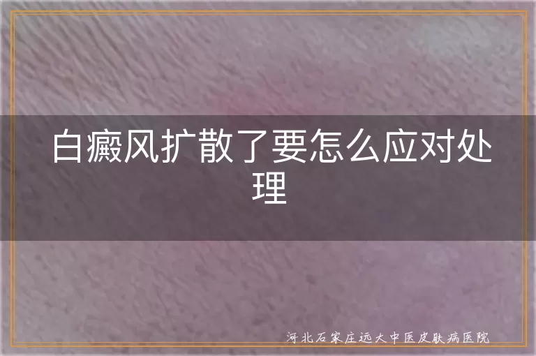 白癜风扩散应对方法,白斑病情控制措施,白癜风扩散后如何处理