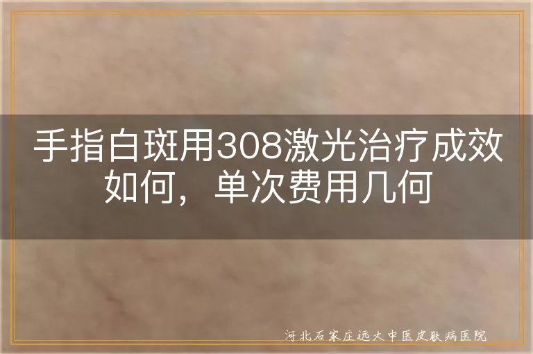 手指白斑308激光治疗效果如何,手指白癜风308激光治疗单次价格,308激光治疗手指部位白斑费用