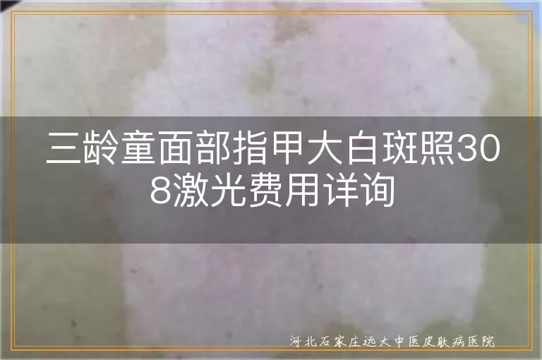 儿童面部白癜风308激光治疗费用,三龄童白斑308照光价格咨询,小儿白斑单次308激光治疗成本