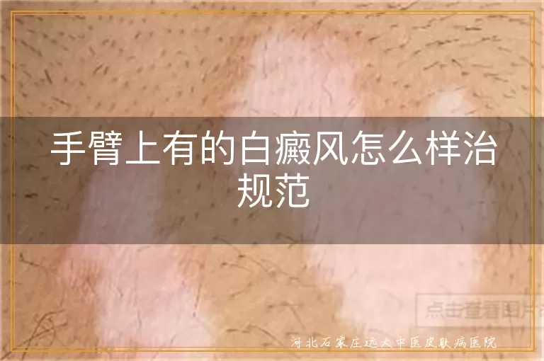手臂上有的白癜风怎么样治规范