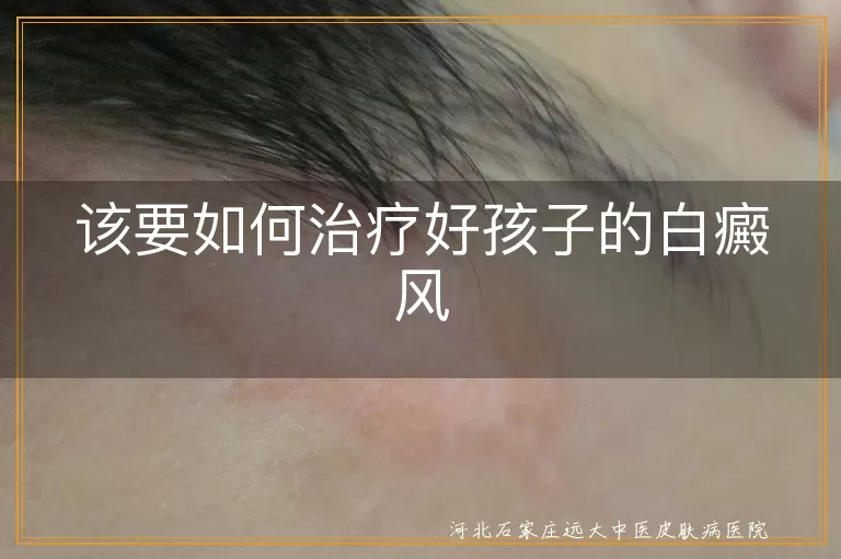 儿童白癜风科学治疗手段,儿童白斑综合干预方案,青少年白癜风康复方法