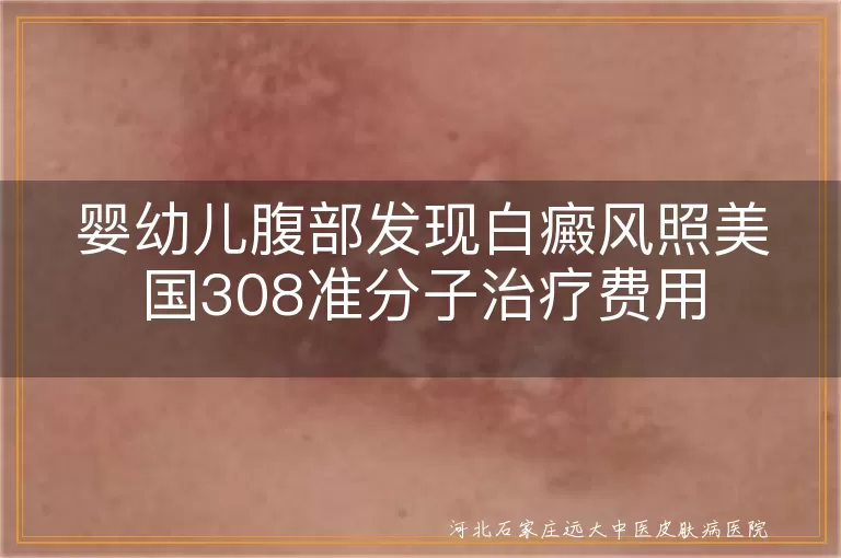 婴幼儿腹部白癜风治疗费用,美国308准分子激光治疗白斑费用,儿童白斑308激光治疗成本