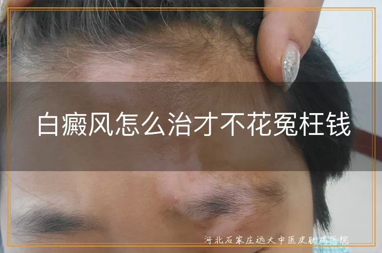 白癜风科学治疗省钱方法,白癜风精准治疗避免误区,白斑规范诊疗降低费用