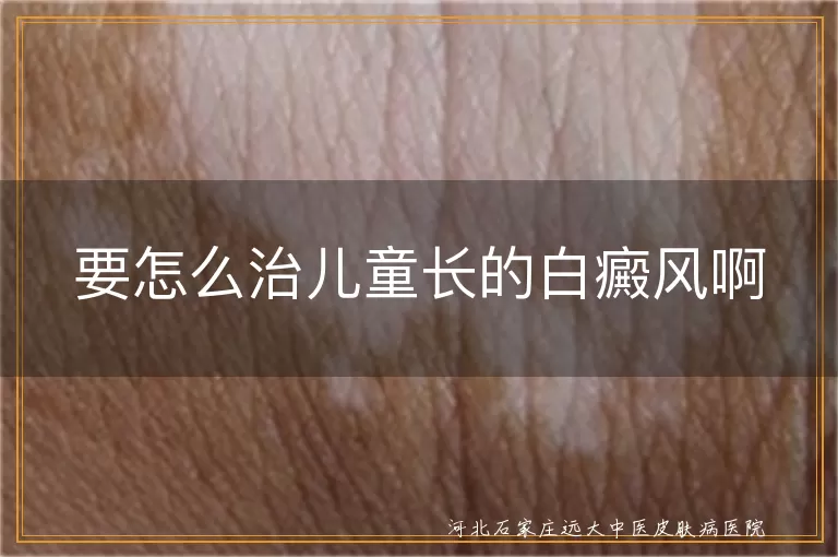 儿童白癜风综合治疗方案,儿童白斑科学治疗方法,儿童白癜风个性化诊疗