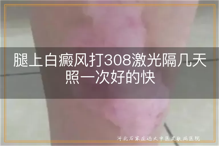白癜风308激光治疗间隔时间,腿部白斑308激光照射频率,308激光治疗白斑疗程规划