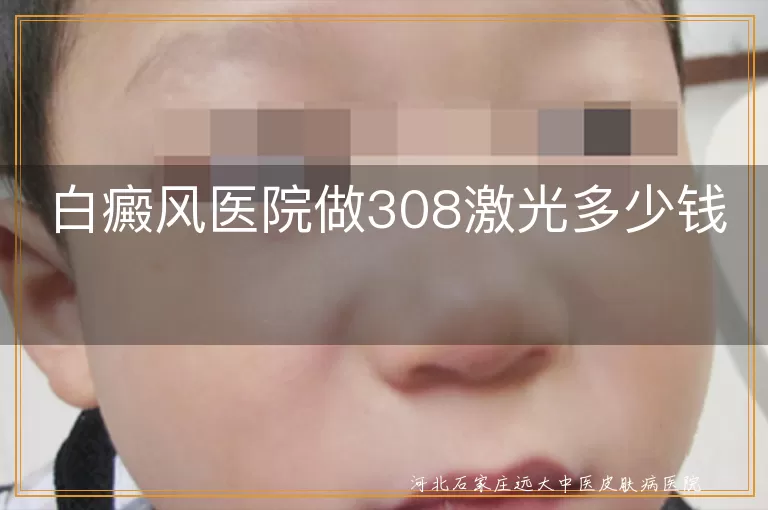 白癜风308激光治疗费用解析,白斑做308激光价格影响因素,白癜风308激光治疗收费标准