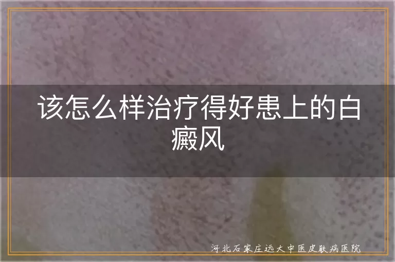 白癜风综合治疗方案,进展期白斑如何控制,白癜风治疗注意事项