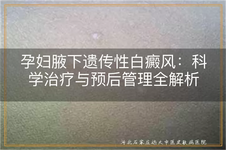 孕妇遗传性白斑科学治疗,孕妇腋下白癜风治疗,遗传性白斑能否治愈
