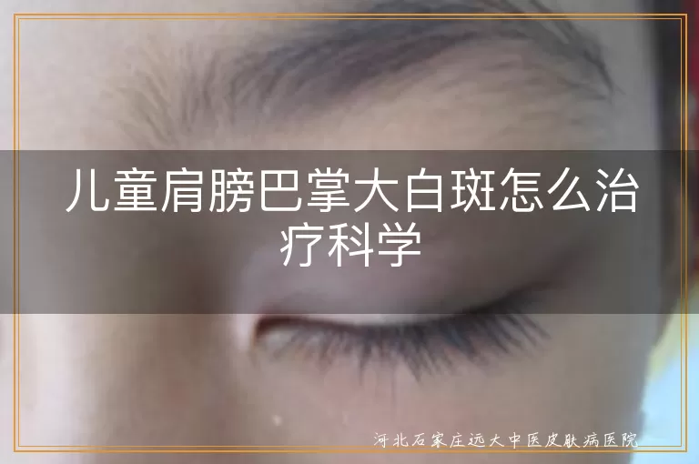 儿童肩膀白斑科学治疗方法,儿童白癜风肩膀部位治疗策略,儿童白斑治疗原则与方案