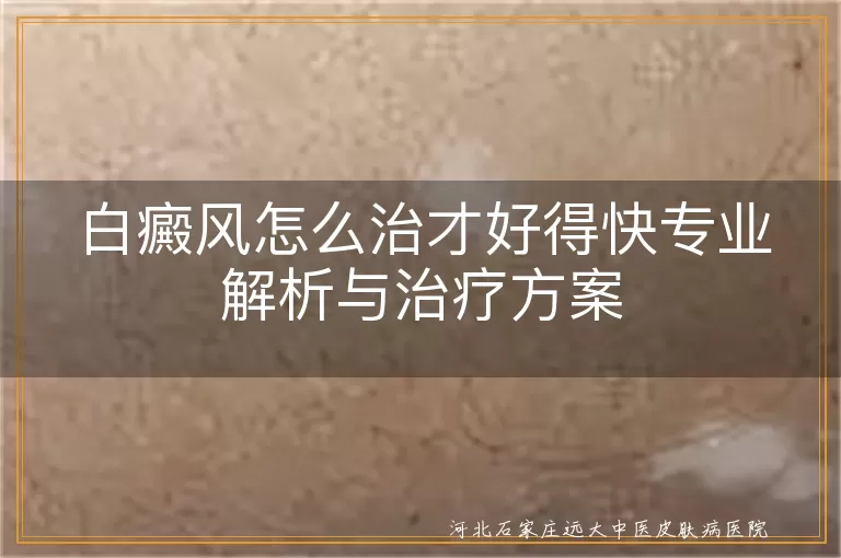 白癜风综合治疗快速康复方案,白斑治疗周期与疗效优化,白癜风多维度联合治疗策略