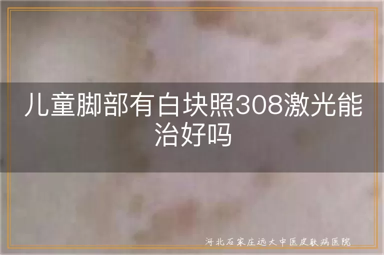 儿童脚部白斑308激光治疗效果,儿童白癜风308激光治疗可行性,308激光治疗儿童脚部白斑效果