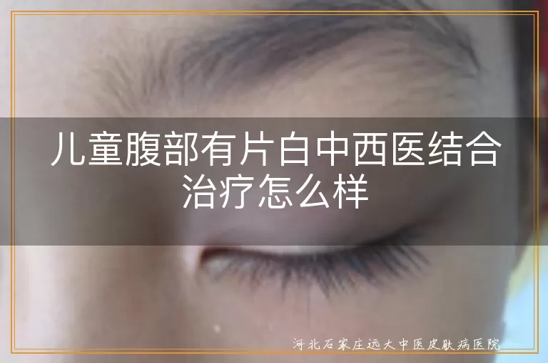 儿童腹部白斑中西医结合治疗优势,儿童白癜风中西医联合疗法,儿童腹部白斑中西医结合方案