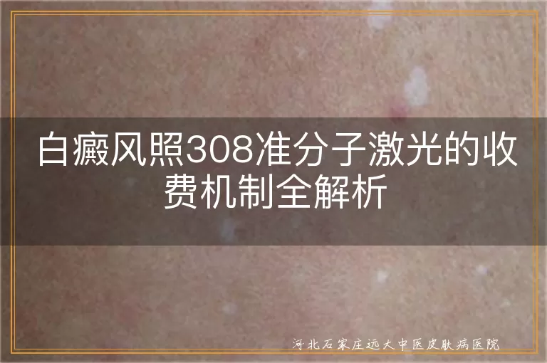 白癜风308激光治疗费用标准,白斑308准分子激光收费影响因素,白癜风照308激光的计价方式