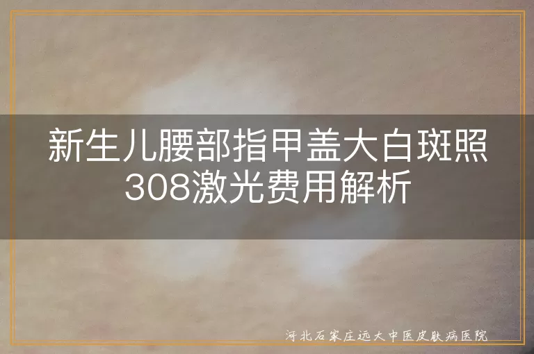 新生儿腰部白斑治疗费用,308激光治疗白癜风价格,儿童白癜风照光收费标准