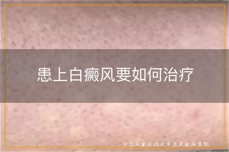 白癜风综合治疗方法,白斑早期干预策略,白癜风个性化治疗方案