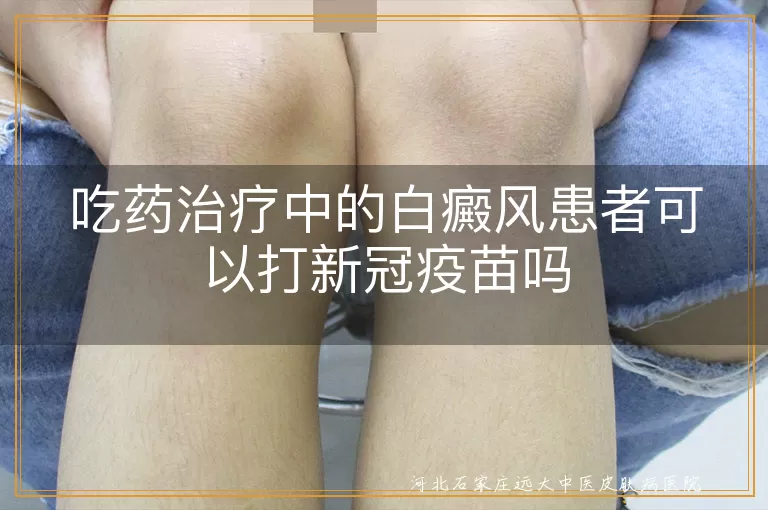白癜风患者接种新冠疫苗注意事项,治疗期白斑患者能否打疫苗,白癜风用药期间疫苗接种指导