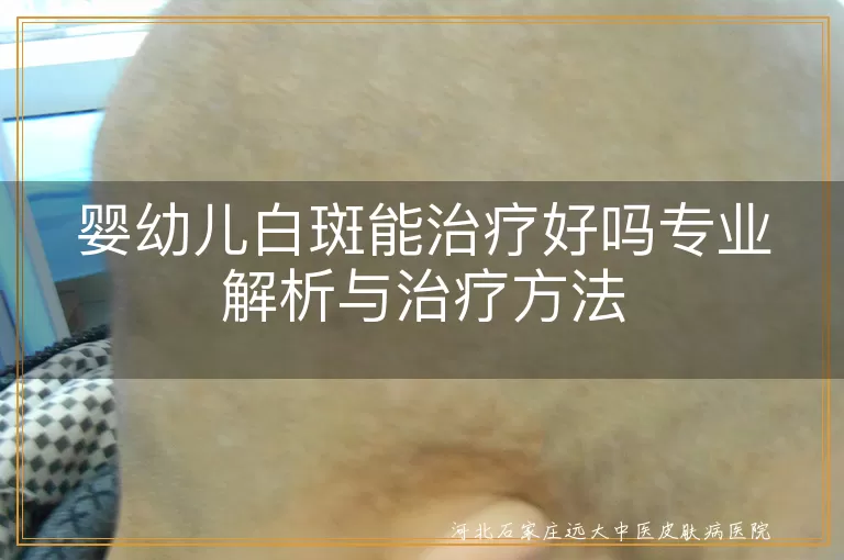 婴幼儿白斑能否治愈,白癜风早期治疗手段,儿童白斑科学诊疗方案