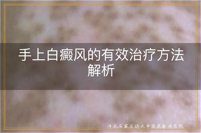 手上白癜风的有效治疗方法解析
