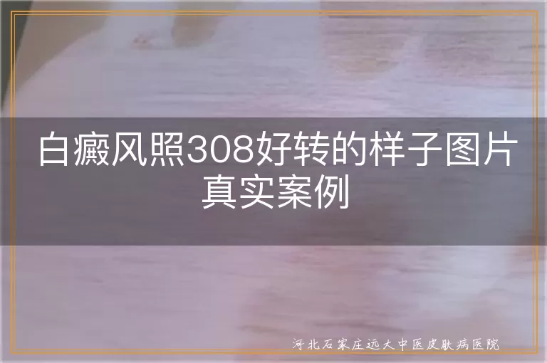 白癜风308激光治疗真实好转案例,白斑患者308照光复色过程图,白癜风308激光治疗前后对比实录
