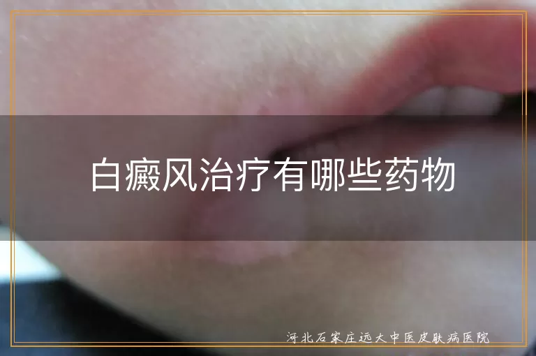 白癜风治疗有哪些药物